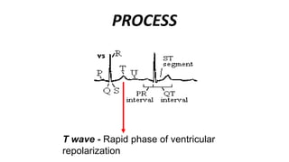 Repolarization Model ECG ( Electrocardiogram) | PPT