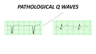 Path Q Wave ECG ( Electrocardiogram) | PPT