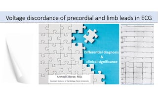 Voltage discordance of precordial and limb leads in ECG
Ahmed ElBorae, MSc
Assistant lecturer of Cardiology, Cairo University
Differential diagnosis
&
clinical significance
 