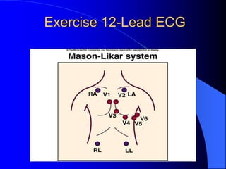 Exercise 12-Lead ECG
 