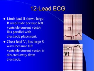 12-Lead ECG
 Limb lead II shows large
R amplitude because left
ventricle current vector
lies parallel with
electrode placement.
 Chest lead V1 has large S
wave because left
ventricle current vector is
directed away from
electrode.
 