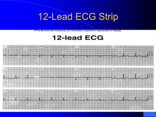 12-Lead ECG Strip
 