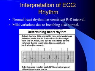 Interpretation of ECG:
Rhythm
• Normal heart rhythm has consistent R-R interval.
• Mild variations due to breathing also normal.
 