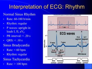 Interpretation of ECG: Rhythm
Normal Sinus Rhythm
• Rate: 60-100 b/min
• Rhythm: regular
• P waves: upright in
leads I, II, aVF
• PR interval: < .20 s
• QRS: < .10 s
Sinus Bradycardia
• Rate: < 60 bpm
• Rhythm: regular
Sinus Tachycardia
• Rate: > 100 bpm
 