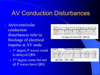 AV Conduction Disturbances
o Atrioventricular
conduction
disturbances refer to
blockage of electrical
impulse at AV node.
o 1st degree P waves result
in delayed QRS.
o 2nd degree some but not
all P waves have QRS.
 