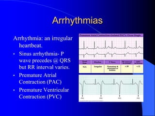 Arrhythmias
Arrhythmia: an irregular
heartbeat.
• Sinus arrhythmia- P
wave precedes @ QRS
but RR interval varies.
• Premature Atrial
Contraction (PAC)
• Premature Ventricular
Contraction (PVC)
 