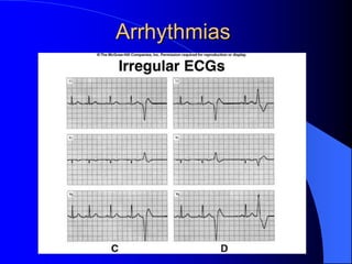 Arrhythmias
 