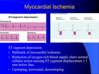 Myocardial Ischemia
ST segment depression.
• Hallmark of myocardial ischemia.
• Reduction of oxygen-rich blood supply alters normal
cellular action causing ST segment displacement ≥ 1
mm below line.
• Upsloping, horizontal, downsloping
 