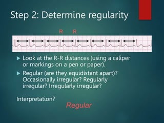 Step 2: Determine regularity
 Look at the R-R distances (using a caliper
or markings on a pen or paper).
 Regular (are they equidistant apart)?
Occasionally irregular? Regularly
irregular? Irregularly irregular?
Interpretation?
Regular
R R
 