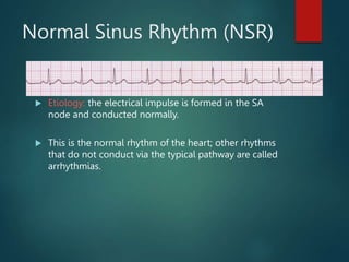 Normal Sinus Rhythm (NSR)
 Etiology: the electrical impulse is formed in the SA
node and conducted normally.
 This is the normal rhythm of the heart; other rhythms
that do not conduct via the typical pathway are called
arrhythmias.
 