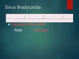 Sinus Bradycardia
Deviation from NSR
- Rate < 60 bpm
 
