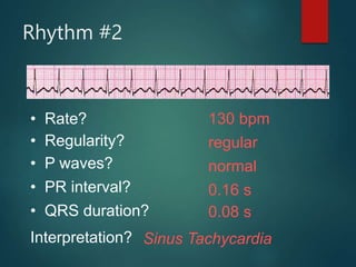 Rhythm #2
130 bpm
• Rate?
• Regularity? regular
normal
0.08 s
• P waves?
• PR interval? 0.16 s
• QRS duration?
Interpretation? Sinus Tachycardia
 