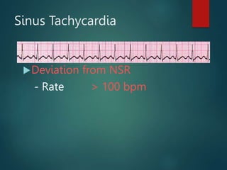 Sinus Tachycardia
Deviation from NSR
- Rate > 100 bpm
 