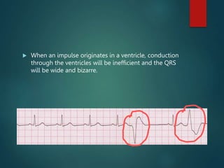  When an impulse originates in a ventricle, conduction
through the ventricles will be inefficient and the QRS
will be wide and bizarre.
 