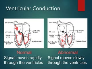 Ventricular Conduction
Normal
Signal moves rapidly
through the ventricles
Abnormal
Signal moves slowly
through the ventricles
 