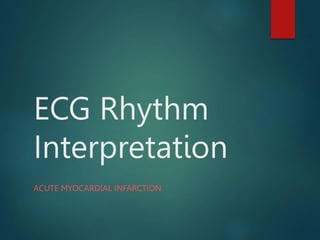 ECG Rhythm
Interpretation
ACUTE MYOCARDIAL INFARCTION
 