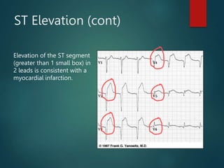 ST Elevation (cont)
Elevation of the ST segment
(greater than 1 small box) in
2 leads is consistent with a
myocardial infarction.
 