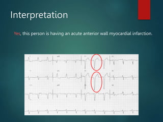 Interpretation
Yes, this person is having an acute anterior wall myocardial infarction.
 
