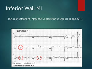 Inferior Wall MI
This is an inferior MI. Note the ST elevation in leads II, III and aVF.
 