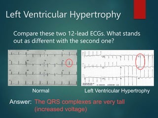 Left Ventricular Hypertrophy
Compare these two 12-lead ECGs. What stands
out as different with the second one?
Normal Left Ventricular Hypertrophy
Answer: The QRS complexes are very tall
(increased voltage)
 