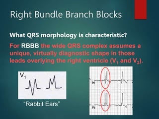 ECG | PPT