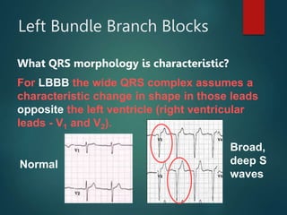 Left Bundle Branch Blocks
What QRS morphology is characteristic?
For LBBB the wide QRS complex assumes a
characteristic change in shape in those leads
opposite the left ventricle (right ventricular
leads - V1 and V2).
Broad,
deep S
waves
Normal
 