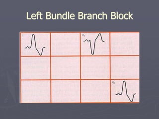 Partial Left Bundle ecg.pptx