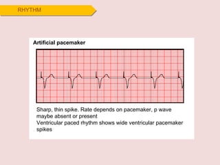 P Wave Pacemaker ecg.pdf