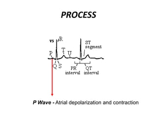 PROCESS
P Wave - Atrial depolarization and contraction
 