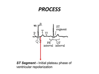 PROCESS
ST Segment - Initial plateau phase of
ventricular repolarization
 