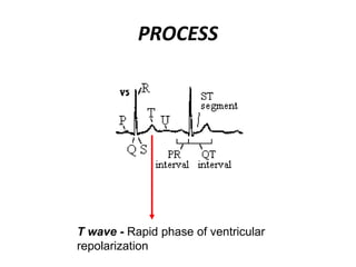 PROCESS
T wave - Rapid phase of ventricular
repolarization
 