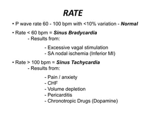 RATE
• P wave rate 60 - 100 bpm with <10% variation - Normal
• Rate < 60 bpm = Sinus Bradycardia
- Results from:
- Excessive vagal stimulation
- SA nodal ischemia (Inferior MI)
• Rate > 100 bpm = Sinus Tachycardia
- Results from:
- Pain / anxiety
- CHF
- Volume depletion
- Pericarditis
- Chronotropic Drugs (Dopamine)
 