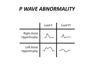 P WAVE ABNORMALITY
 