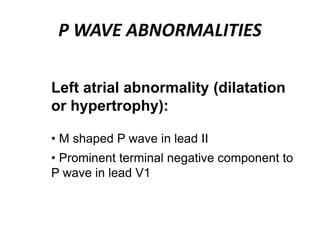 P WAVE ABNORMALITIES
Left atrial abnormality (dilatation
or hypertrophy):
• M shaped P wave in lead II
• Prominent terminal negative component to
P wave in lead V1
 