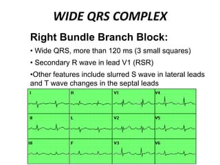 WIDE QRS COMPLEX
Right Bundle Branch Block:
• Wide QRS, more than 120 ms (3 small squares)
• Secondary R wave in lead V1 (RSR)
•Other features include slurred S wave in lateral leads
and T wave changes in the septal leads
 