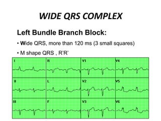 WIDE QRS COMPLEX
Left Bundle Branch Block:
• Wide QRS, more than 120 ms (3 small squares)
• M shape QRS , R’R’
 