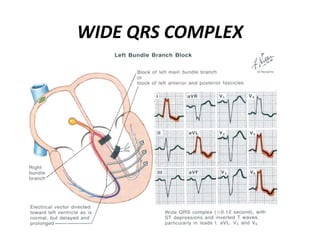 WIDE QRS COMPLEX
 