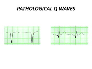 PATHOLOGICAL Q WAVES
 