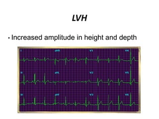 LVH
• Increased amplitude in height and depth
 
