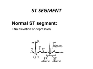 ST SEGMENT
Normal ST segment:
• No elevation or depression
 