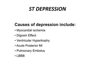 ST DEPRESSION
Causes of depression include:
• Myocardial ischemia
• Digoxin Effect
• Ventricular Hypertrophy
• Acute Posterior MI
• Pulmonary Embolus
• LBBB
 