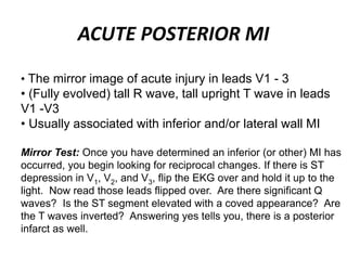 ACUTE POSTERIOR MI
• The mirror image of acute injury in leads V1 - 3
• (Fully evolved) tall R wave, tall upright T wave in leads
V1 -V3
• Usually associated with inferior and/or lateral wall MI
Mirror Test: Once you have determined an inferior (or other) MI has
occurred, you begin looking for reciprocal changes. If there is ST
depression in V1, V2, and V3, flip the EKG over and hold it up to the
light. Now read those leads flipped over. Are there significant Q
waves? Is the ST segment elevated with a coved appearance? Are
the T waves inverted? Answering yes tells you, there is a posterior
infarct as well.
 