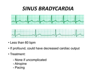 SINUS BRADYCARDIA
• Less than 60 bpm
• If profound, could have decreased cardiac output
• Treatment:
- None if uncomplicated
- Atropine
- Pacing
 