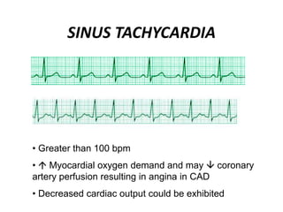 SINUS TACHYCARDIA
• Greater than 100 bpm
•  Myocardial oxygen demand and may  coronary
artery perfusion resulting in angina in CAD
• Decreased cardiac output could be exhibited
 