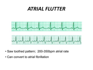 ATRIAL FLUTTER
• Saw toothed pattern; 200-350bpm atrial rate
• Can convert to atrial fibrillation
 