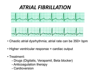 ATRIAL FIBRILLATION
• Chaotic atrial dysrhythmia; atrial rate can be 350+ bpm
• Higher ventricular response = cardiac output
• Treatment:
- Drugs (Digitalis, Verapamil, Beta blocker)
- Anticoagulation therapy
- Cardioversion
 
