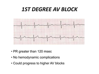 1ST DEGREE AV BLOCK
• PR greater than 120 msec
• No hemodynamic complications
• Could progress to higher AV blocks
 