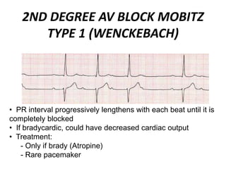 2ND DEGREE AV BLOCK MOBITZ
TYPE 1 (WENCKEBACH)
• PR interval progressively lengthens with each beat until it is
completely blocked
• If bradycardic, could have decreased cardiac output
• Treatment:
- Only if brady (Atropine)
- Rare pacemaker
 