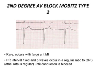 2ND DEGREE AV BLOCK MOBITZ TYPE
2
• Rare, occurs with large ant MI
• PR interval fixed and p waves occur in a regular ratio to QRS
(atrial rate is regular) until conduction is blocked
 