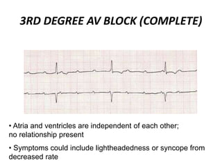 3RD DEGREE AV BLOCK (COMPLETE)
• Atria and ventricles are independent of each other;
no relationship present
• Symptoms could include lightheadedness or syncope from
decreased rate
 